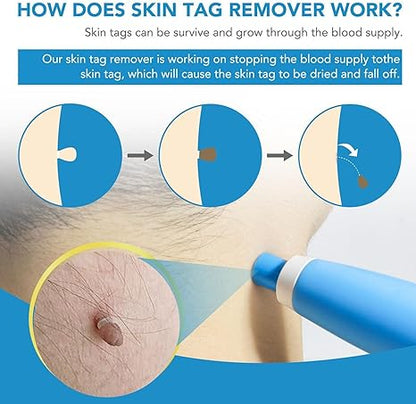 ✨ Acrochordon Skin Tag Remover Kit – 2-in-1 Fast & Painless Solution 🩹💖
